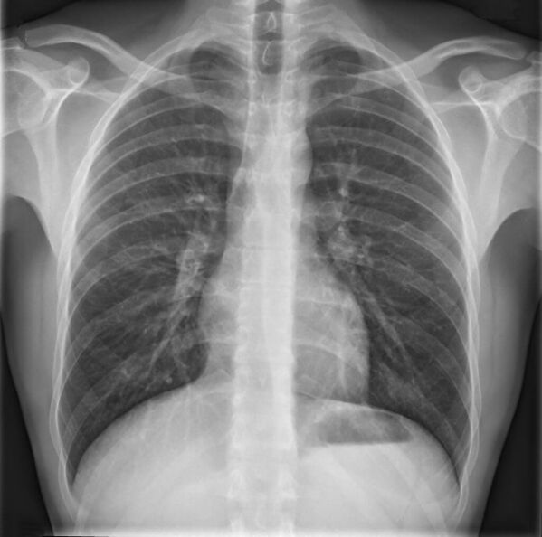 Osteochondrose vun der thoracic Wirbelsäule gëtt diagnostizéiert mat Radiographie
