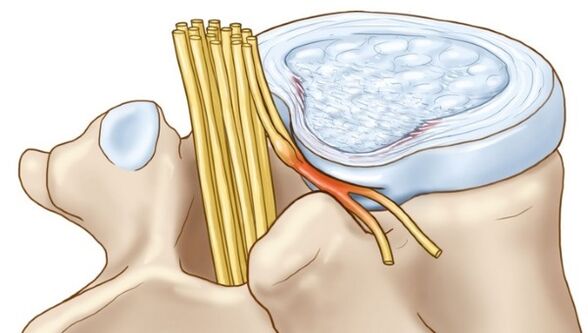 Protrusiounen vun der intervertebral Disc, déi mat der thoracescher Osteochondrose optrieden, kompriméieren d'Nerve Endungen
