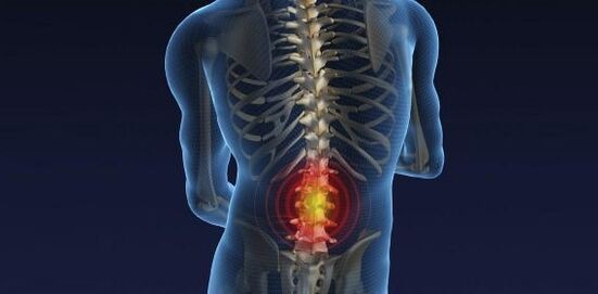 Zréck Péng mat Osteochondrosis vum Lendung