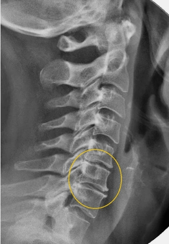 Osteochondrosis vun der Gebärmutteralpräif op enger X -ray
