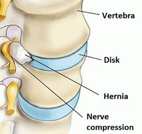 Osteochondrosis vun der Gebärmutterhalter