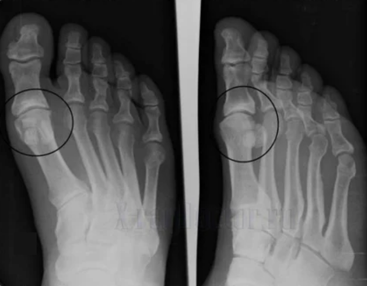 Diagnos vun Arthrosis