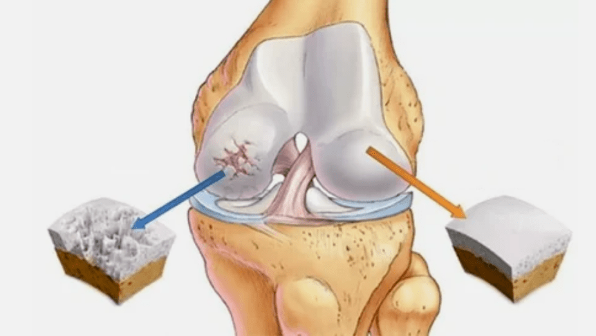 Wéi Arthrosis entwéckelt