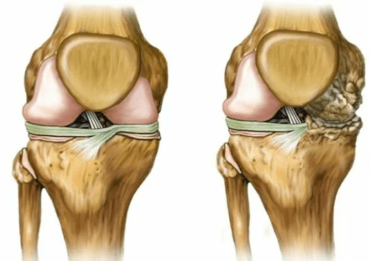 Zänn vun Arthrosis
