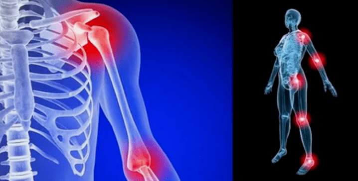limb Deformatioun fir Arthrosis