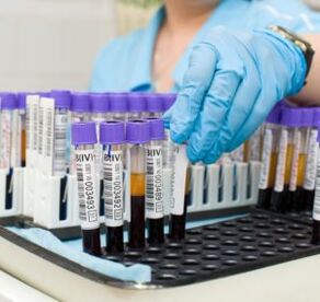 Blutt Test fir Gelenkschmerzen ze diagnostizéieren