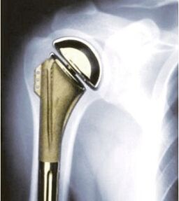 Schëller Ersatz fir Arthrosis