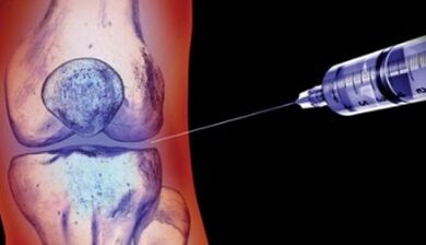 Methoden fir d'Behandlung vun Arthrosis vun de Gelenker