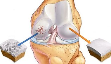 Ursaachen vun Arthrosis vun de Gelenker