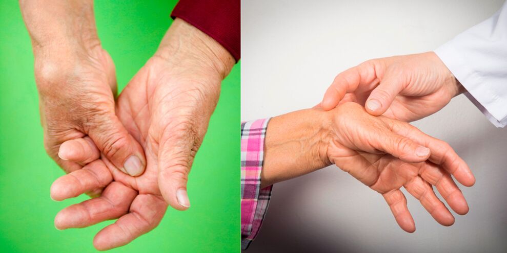 Schwellung an schmerzende Schmäerzen sinn déi éischt Unzeeche vun der Hand Arthritis