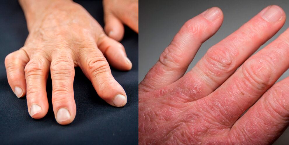 rheumatoide a psoriatescher Arthritis vun den Hänn