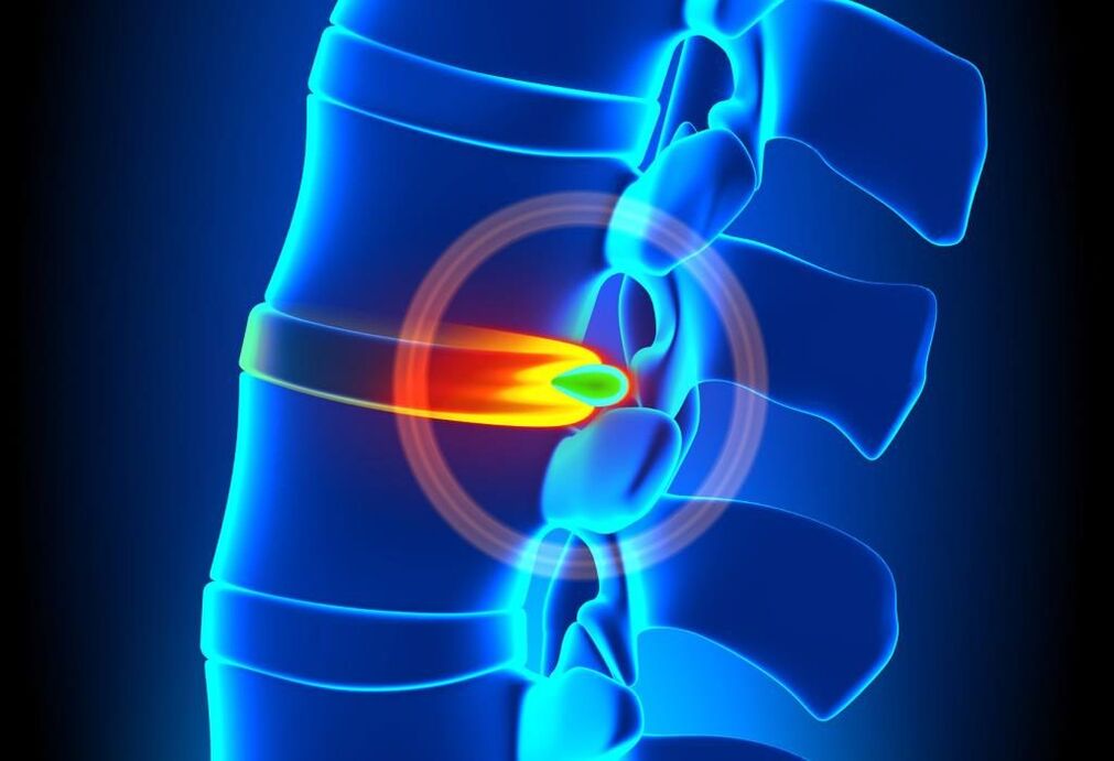 Spinal Läsion mat Gebärmutterhalskierper Osteochondrose