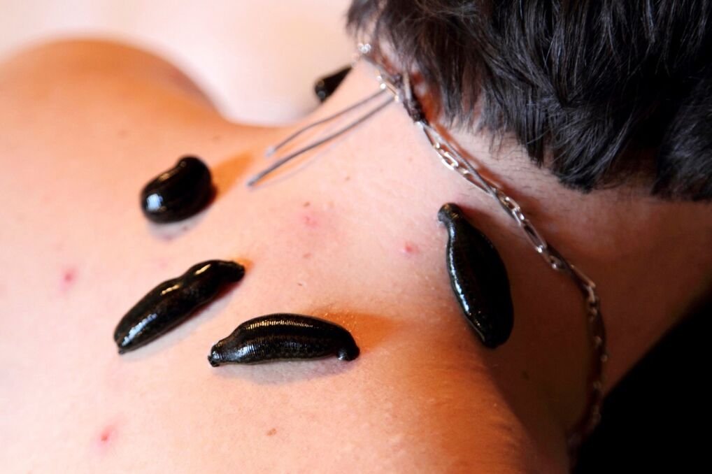 Leech fir zervikal Osteochondrose