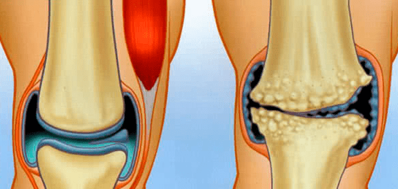 Normal Gelenk an Arthrosis